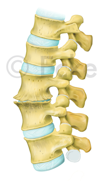 Osteochondrose