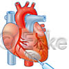 Herzinjektion