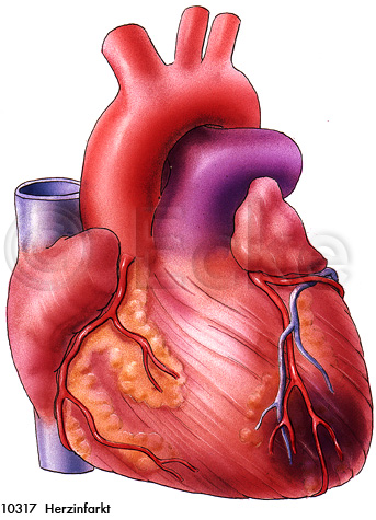 Herzinfarkt 01