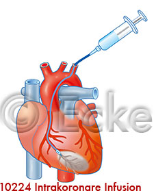 Herzkranzinfusion