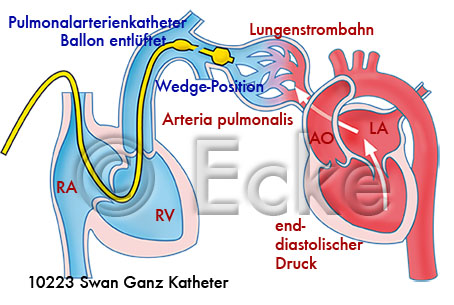 Swan Ganz Katheter