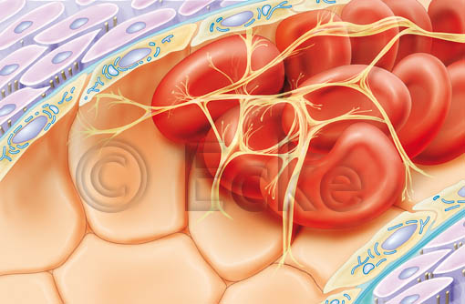 Thrombus 1