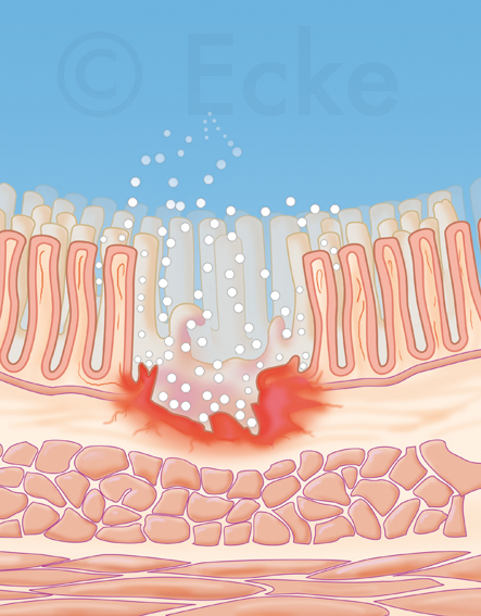 Darmschleimhaut Ulcus