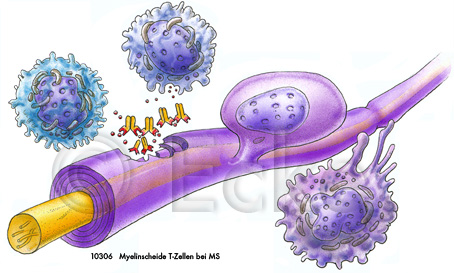 Myelinscheide MS