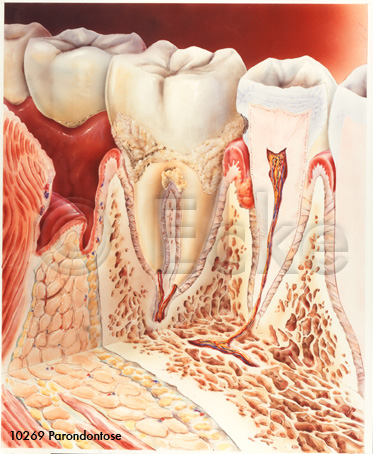 Parodontose