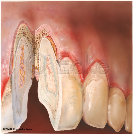 Parodontose Parondontitis