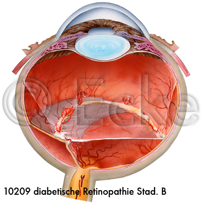 Retinopathie B