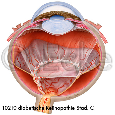 Retinopathie C