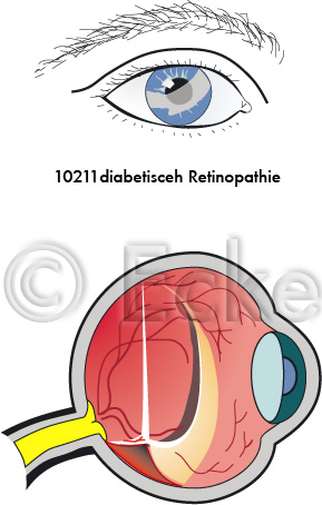 Sehstoerung