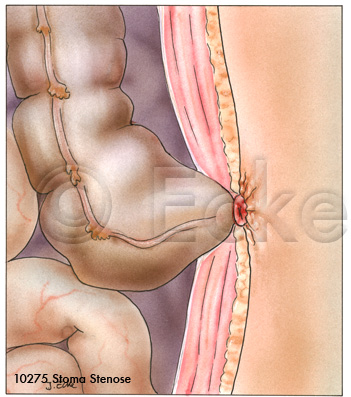 Stoma Stenose