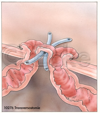 Transversostomie Querschnitt