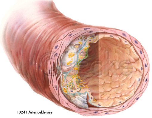 Arteriosklerose 5
