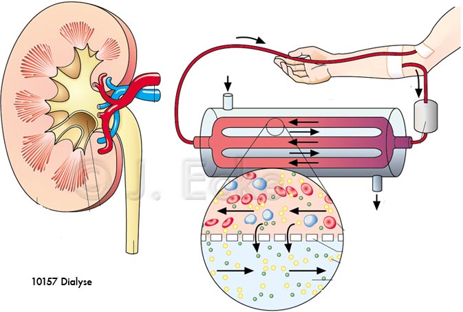 Dialyse