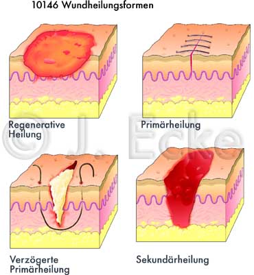 Wundheilung