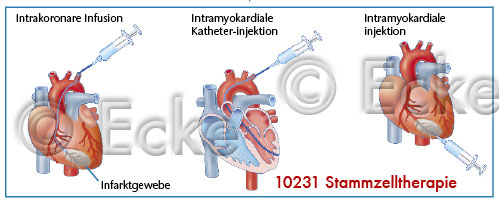 Stammzelltherapie 4